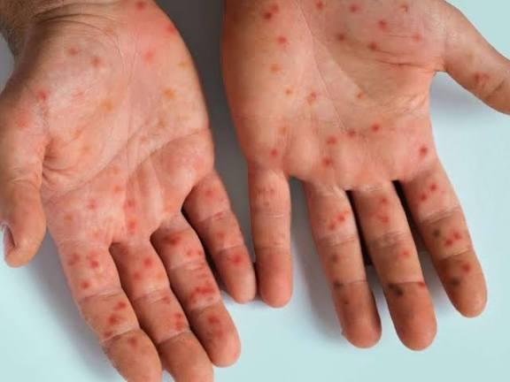 Mpox no Brasil